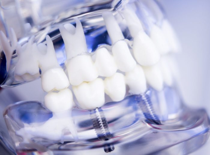 Implante dental: múltiples beneficios para tu salud bucodental