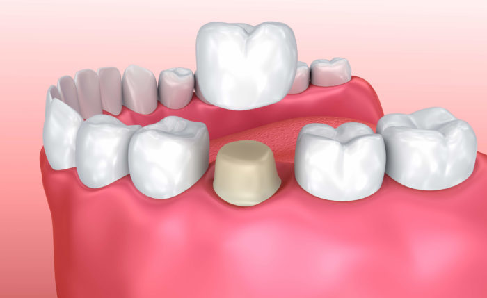 ¿Qué es y para que sirve una Corona dental?